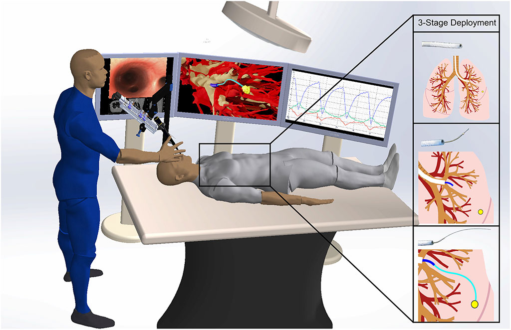 Image: An overview of the semiautonomous medical robot’s three stages in the lungs (Photo courtesy of UNC School of Medicine)