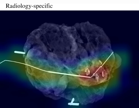 Image: The AI model improves tumor removal accuracy during breast cancer surgery (Photo courtesy of UNC School of Medicine)