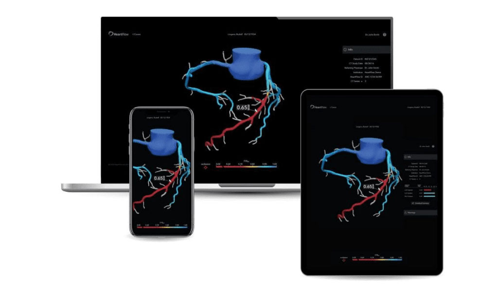 Image: HeartFlow FFRCT Analysis has been shown to significantly decrease cardiovascular mortality (Photo courtesy of HeartFlow Inc.)