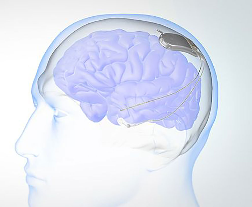 Image: For the first time, one electrode targets two portions of brain for dual benefit (Photo courtesy of OHSU)