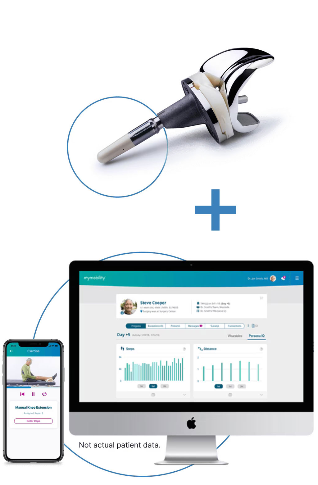 Image: Persona IQ is a first-to-world smart knee implant that captures relevant gait metrics (Photo courtesy of Zimmer Biomet)