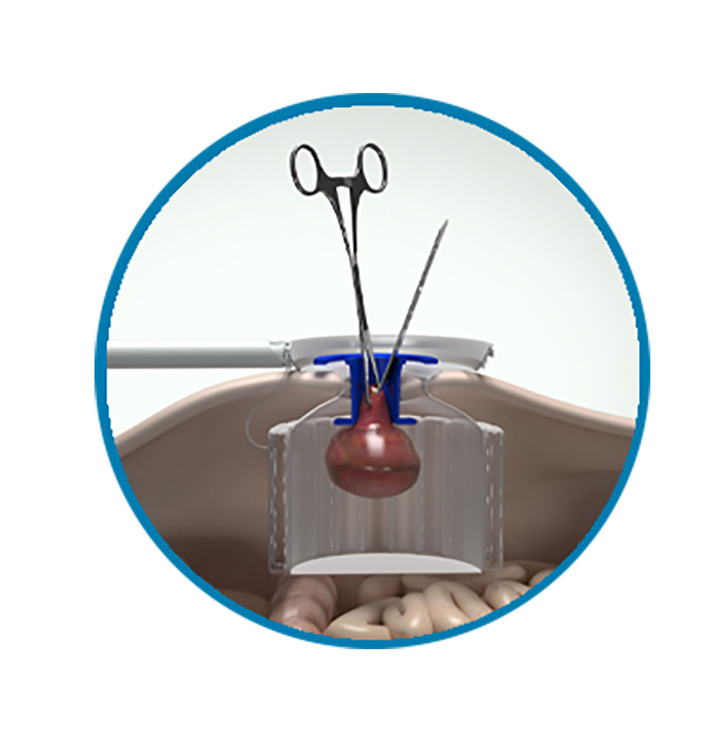 Image: The LapBox is designed for the safe and simple removal of tissue (Photo courtesy of Ark Surgical)