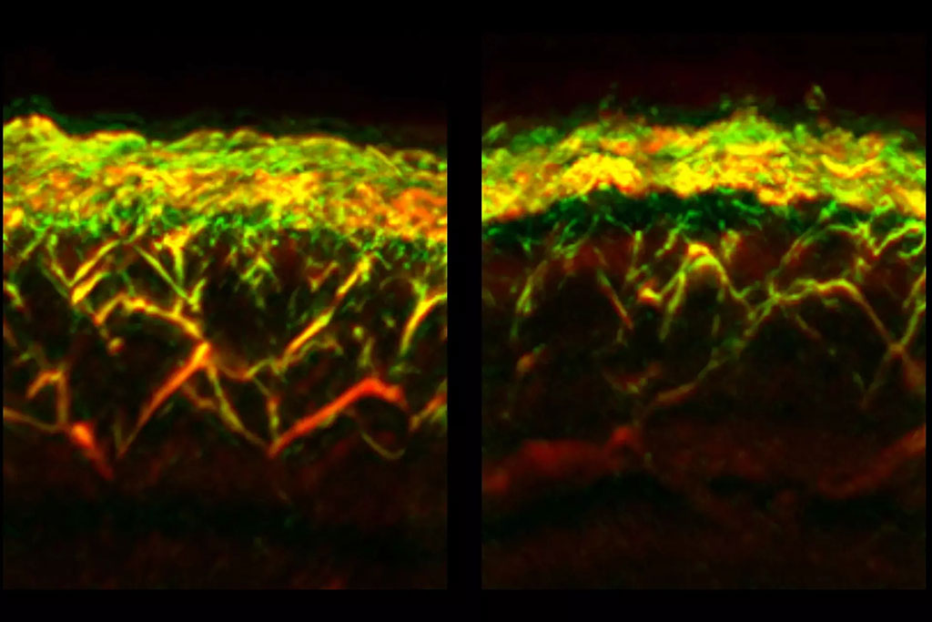 Image: RSOM images of the skin of a healthy volunteer (left) and a patient with diabetes (Photo courtesy of TUM)