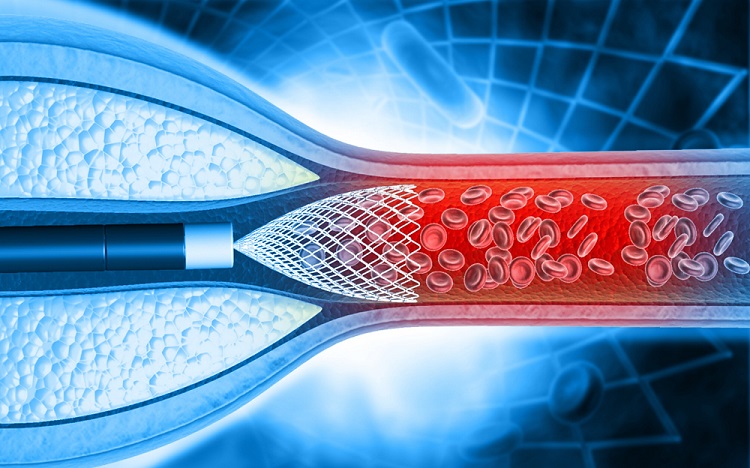 Image: The AI tool represents a significant step forward in improving clinical decision-making for patients undergoing PCI (Photo courtesy of 123RF)