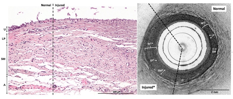 Image: Ureteral electrothermal injury is visible via histology ex vivo (Photo courtesy of Long et al., doi 10.1117/1.BIOS.1.1.015001)
