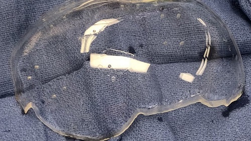 Image: Clear experimental skull implant may enable functional ultrasound imaging of the brain for patients with serious head injuries (Photo courtesy of Todd Patterson)