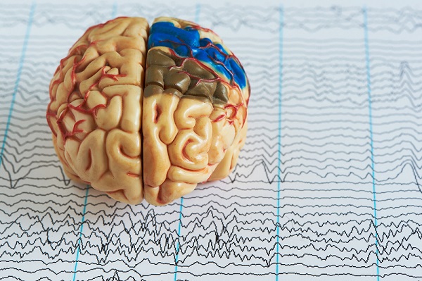 Image: The new AI system accurately detects epileptic seizure types (Photo courtesy of 123RF)