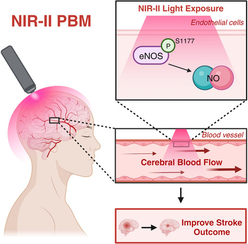 Image: Noninvasive laser therapy could be an effective new treatment for stroke patients (Photo courtesy of Stroke DOI: 10.1161/STROKEAHA.123.045358)