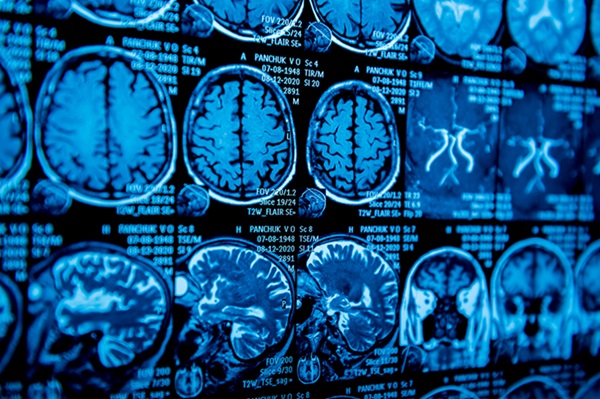 Image: The study results point to a role for MRI in intervention trials to prevent or delay the progression of Parkinson\'s disease (Photo courtesy of 123RF) Image: The study results point to a role for MRI in intervention trials to prevent or delay the progression of Parkinson\'s disease (Photo courtesy of 123RF)