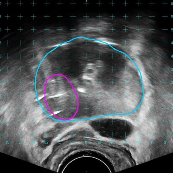 Image: The software allows surgeons to view MR contours on the live ultrasound (Photo courtesy of MIM Software) Image: The software allows surgeons to view MR contours on the live ultrasound (Photo courtesy of MIM Software)