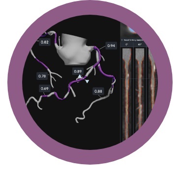 Image: HeartFlow Plaque Analysis leverages cutting-edge AI for assessment of plaque quantity and composition (Photo courtesy of HeartFlow, Inc.) Image: HeartFlow Plaque Analysis leverages cutting-edge AI for assessment of plaque quantity and composition (Photo courtesy of HeartFlow, Inc.)