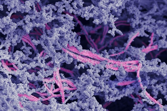 Image: Microstructure of the new bioactive material. The fibers are in pink; hyaluronic acid is shown in purple (Photo courtesy of Stupp Group)