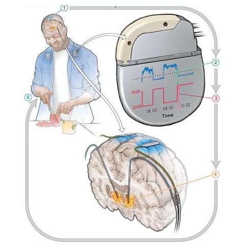 Image: The implanted device responds to changes in brain signals, adjusting the amount of stimulation throughout the day (Photo courtesy of Phillp Starr Lab)