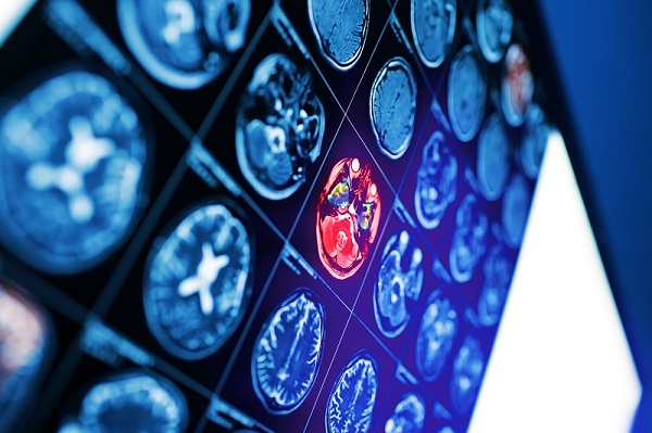 Image: A new paradigm in radiation therapy planning aims to improve treatment outcomes for children with brain tumors (Photo courtesy of 123RF) Image: A new paradigm in radiation therapy planning aims to improve treatment outcomes for children with brain tumors (Photo courtesy of 123RF)