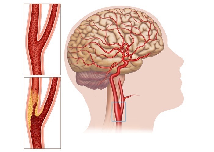 Image: The groundbreaking tool can transform outcomes for stroke intervention (Photo courtesy of Shutterstock)