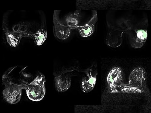 Image: MRI images showing how cancerous tissue can glow in light green imaging (Photo courtesy of University of Waterloo) Image: MRI images showing how cancerous tissue can glow in light green imaging (Photo courtesy of University of Waterloo)