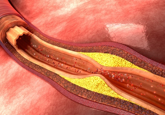 Image: The Carotid Artery Risk (CAR) score offers new options for atherosclerosis patients (Photo courtesy of 123RF)