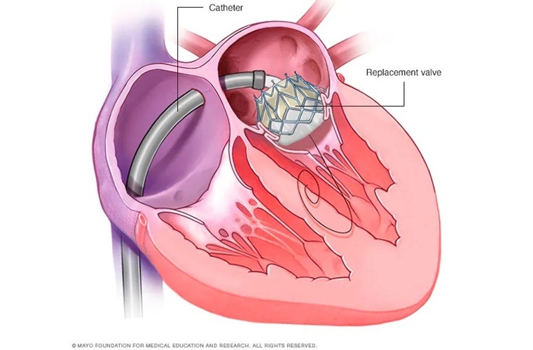 Image: Patients undergoing TMVR experience reduced risk of obstruction and shorter procedure times (Photo courtesy of Mayo Clinic) Image: Patients undergoing TMVR experience reduced risk of obstruction and shorter procedure times (Photo courtesy of Mayo Clinic)