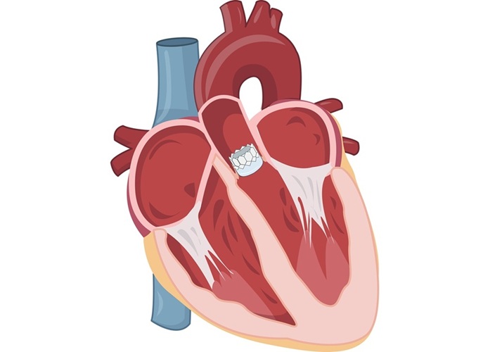 Image: Younger patients with asymptomatic AS who undergo TAVR experience lower rates of serious cardiovascular events (Photo courtesy of Shutterstock) Image: Younger patients with asymptomatic AS who undergo TAVR experience lower rates of serious cardiovascular events (Photo courtesy of Shutterstock)