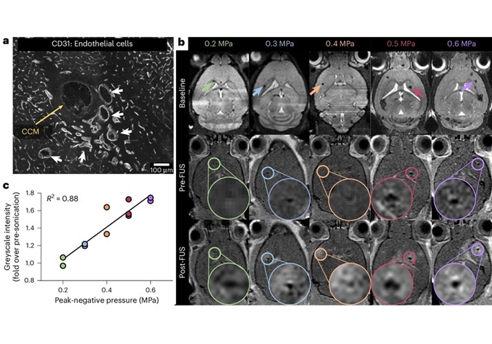 Image: Focused ultrasound can halt the growth of debilitating brain lesions (Photo courtesy of Nature Biomedical Engineering; doi.org/10.1038/s41551-025-01390-z)