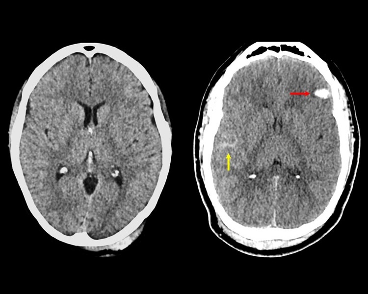 Image: These images show how treatment is impacted by the new TBI framework (Photo courtesy of UCSF) Image: These images show how treatment is impacted by the new TBI framework (Photo courtesy of UCSF)