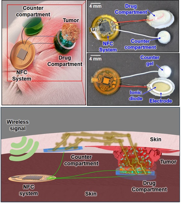 Image: Wireless implantable dual-phoretic drug delivery system (Photo courtesy of Science Advances) Image: Wireless implantable dual-phoretic drug delivery system (Photo courtesy of Science Advances)