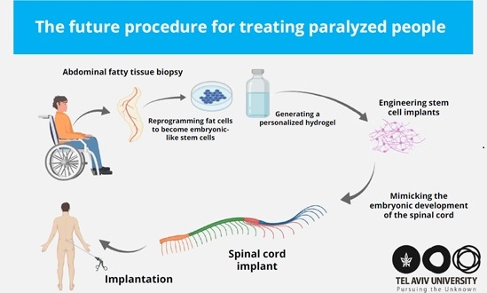 Image: Visualization of the next stage of the research - human spinal cord implants for treating paralysis (Photo courtesy of Sagol Center for Regenerative Biotechnology) Image: Visualization of the next stage of the research - human spinal cord implants for treating paralysis (Photo courtesy of Sagol Center for Regenerative Biotechnology)