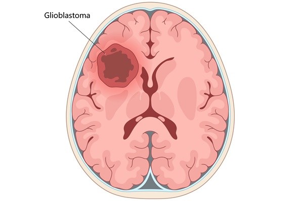 Image: The novel approach combining MRI, fluid dynamics, and custom algorithms predicts brain cancer recurrence sites (photo courtesy of AdobeStock)