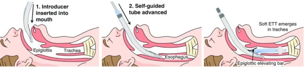 Image: An illustration of how the intubation device is used (Photo courtesy of UC Santa Barbara)