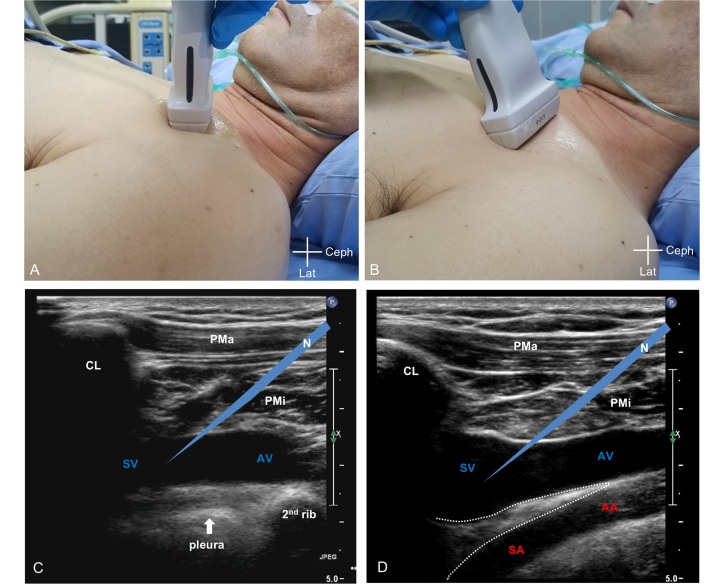 Image: Schematic diagram of applying the SAVES method (right side) compared to the classical approach (R Zhang et al., Journal of Intensive Medicine (2025). DOI: 10.1016/j.ultrasmedbio.2025.03.00489)