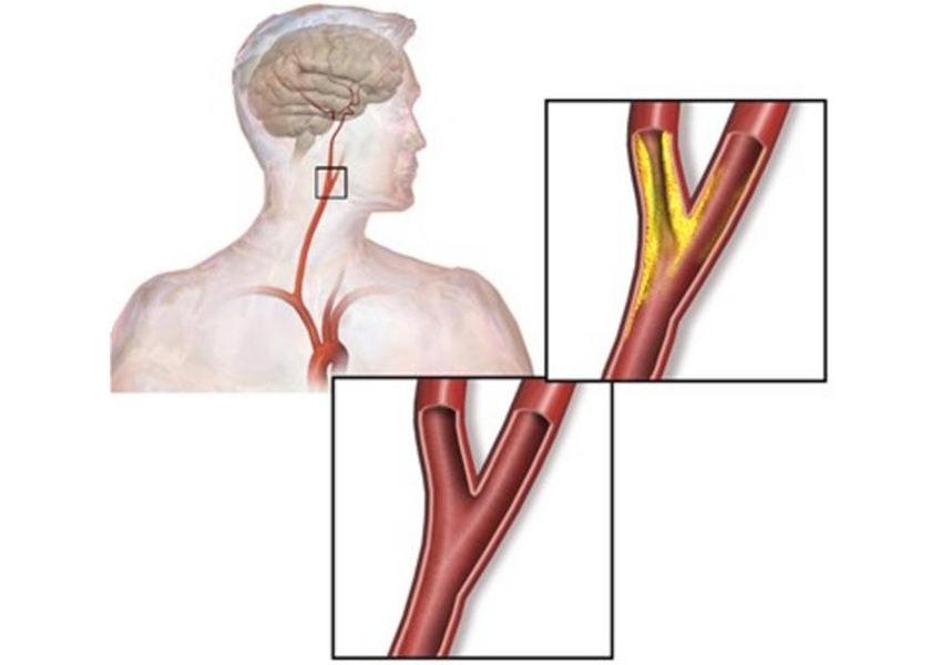 Image: Carotid artery is the blood vessel that supplies oxygen-rich blood to the brain (Photo courtesy of Bruce Blaus/Wikimedia Commons)