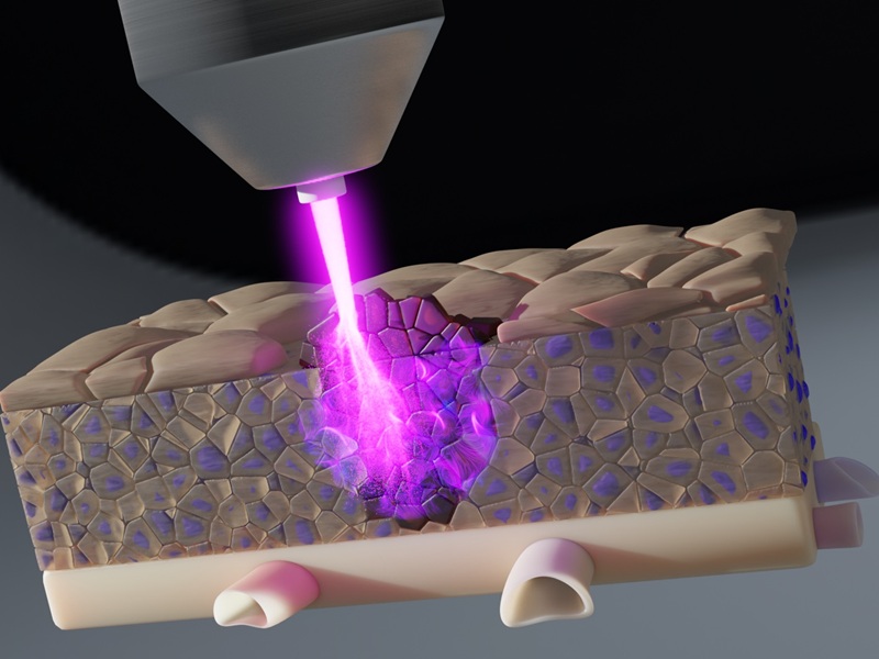 Image: The new approach to fight cancer uses cold plasma that penetrates deep into tissue (Photo courtesy of INP)