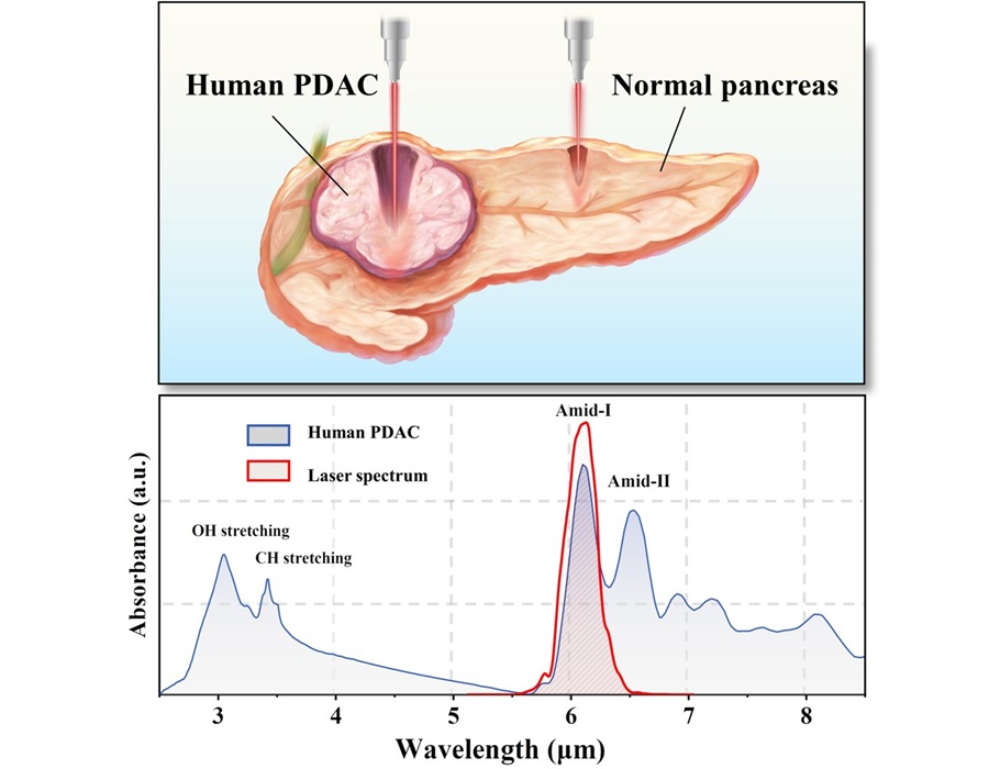 Image: Using a laser wavelength that matches the collagen absorption peak allows selective ablation of PDAC without harming healthy tissue (Photo courtesy of Houkun Liang/Sichuan University) Image: Using a laser wavelength that matches the collagen absorption peak allows selective ablation of PDAC without harming healthy tissue (Photo courtesy of Houkun Liang/Sichuan University)