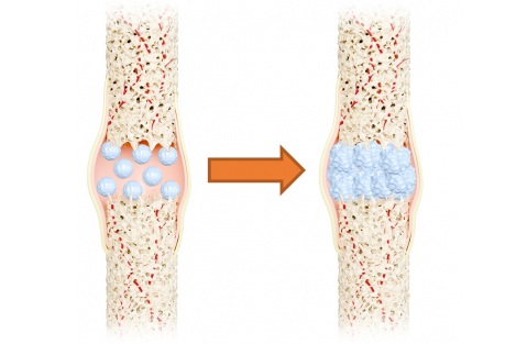 Image: The revolutionary nano bone material with high elasticity and strength can accelerate surgery and healing (Photo courtesy of The University of Hong Kong)