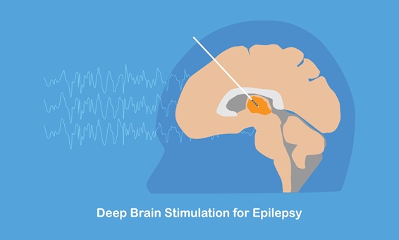 Image: Patient-specific deep brain stimulation dramatically reduces seizures in individuals who do not respond to medication or surgery (Photo courtesy of Shutterstock) Image: Patient-specific deep brain stimulation dramatically reduces seizures in individuals who do not respond to medication or surgery (Photo courtesy of Shutterstock)