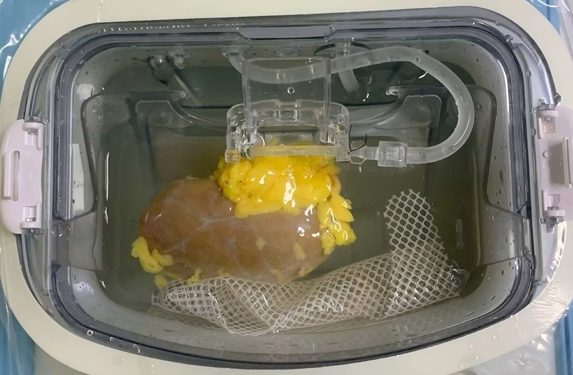 Image: The kidney, pre-transplant, in a perfusion device which is used to circulate a solution that contains the converting enzymes (J Zeng et al., Nat Biomed Eng (2025). DOI: 10.1038/s41551-025-01513-6) Image: The kidney, pre-transplant, in a perfusion device which is used to circulate a solution that contains the converting enzymes (J Zeng et al., Nat Biomed Eng (2025). DOI: 10.1038/s41551-025-01513-6)
