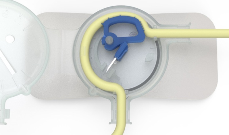 image: Cathetrix is presenting Foley-Safe, the world’s first Foley catheter stabilizer with active protection, at MEDICA 2025 (Photo courtesy of Cathetrix) image: Cathetrix is presenting Foley-Safe, the world’s first Foley catheter stabilizer with active protection, at MEDICA 2025 (Photo courtesy of Cathetrix)