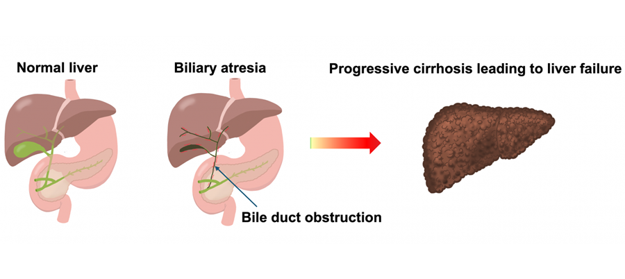 Image: Development of biliary atresia, the leading cause of liver transplants in children (Photo courtesy of Yoichi Nakagawa/Nagoya University)