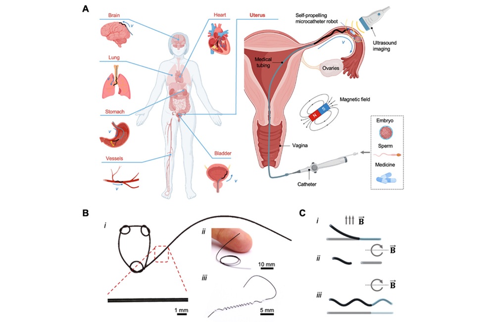 Image: The robotic magnetic microcatheter traverses the cervix into the vagina and fallopian tubes (Z Chen et al., Adv Mater (2025). DOI: 10.1002/adma.202506591)