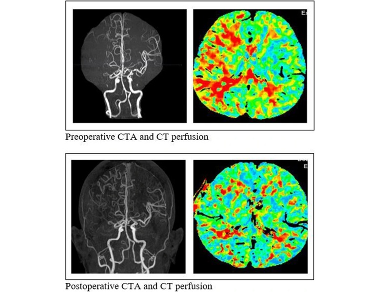 Image: Pre-postoperative CTA and CT perfusion (Photo courtesy of Chinese Neurosurgical Journal, DOI: 10.1186/s41016-025-00413-7)