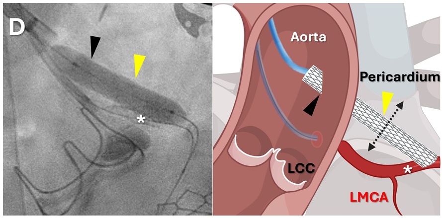 Image: A fluoroscopy image (left) and graphic representation (right) depict a stent graft (yellow arrowhead) being deployed (Photo courtesy of Bruce et al.)