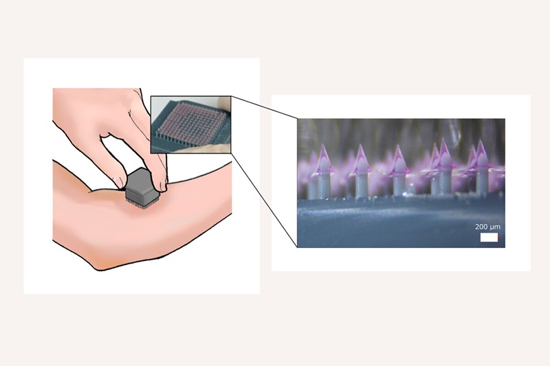 Image: The 3D-printed microneedle patch boosts live-virus vaccine delivery (Photo courtesy of IIS/University of Tokyo)
