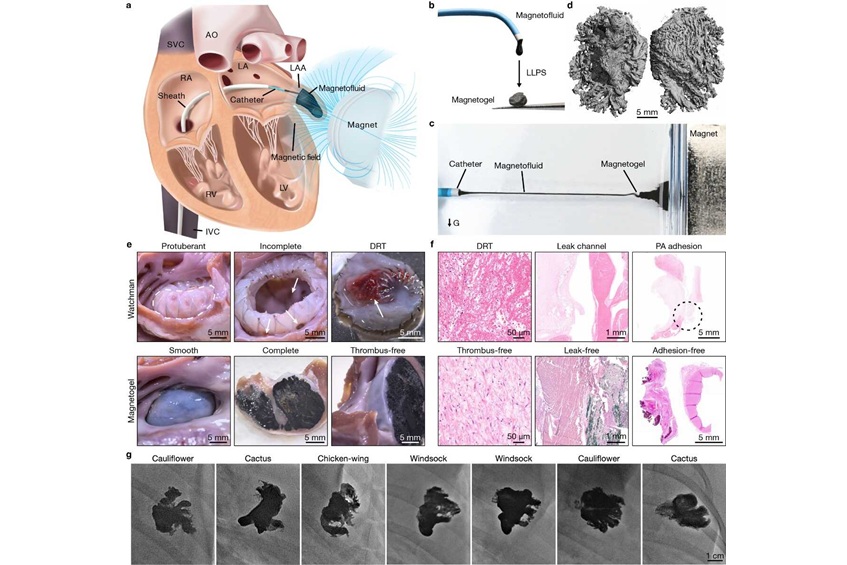 Image: Illustration of magnetofluids-based left atrial appendage occlusion and display of occlusion results (Photo courtesy of SIAT)