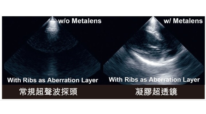 Image: The SonoMeta MetaLens guides ultrasound waves through the rib cage for clearer imaging of the heart and lungs (Photo courtesy of HKU)