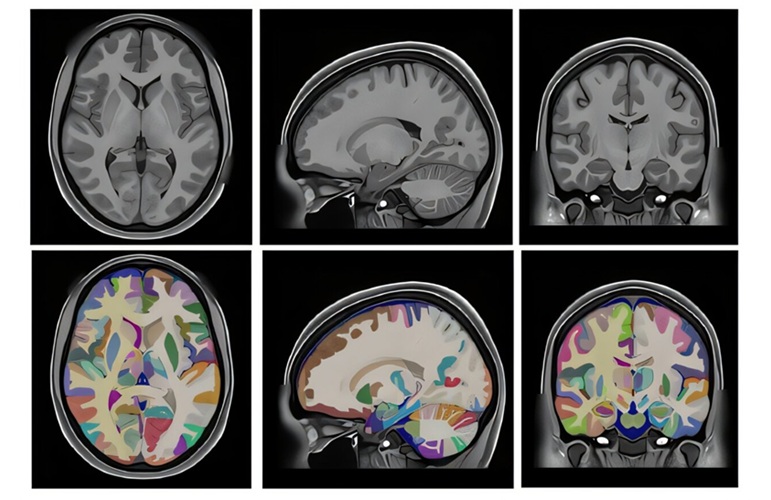 HoliAtlas Project Brain Images (Photo courtesy of ITACA, Universitat Politècnica de València) HoliAtlas Project Brain Images (Photo courtesy of ITACA, Universitat Politècnica de València)
