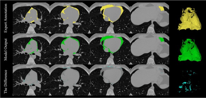 Image: Pericardial adipose tissue (PAT) segmentation: A visual comparison of the ground truth segmentations of the PAT (upper row), model’s predictions (middle row) and the subtraction of two masks. From left to the right, columns represent 2D axial slices from upper to lower heart levels and the rightmost column corresponds to the 3D representation of the masked region (Zahra Esmaeili et al. American Journal of Preventive Cardiology (2026). DOI: 10.1016/j.ajpc.2026.101549)