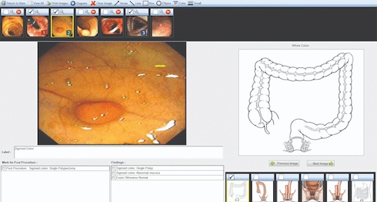 Image: Provation Mira Documentation Assist allows clinicians to seamlessly document findings and maneuvers for colonoscopies by speaking naturally (photo courtesy of Provation)