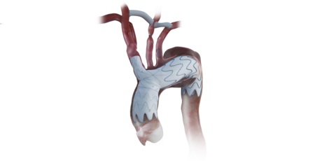 Image: The NEXUS System is a bimodular construct designed to mimic ascending aorta and arch anatomy (photo courtesy of Endospan)
