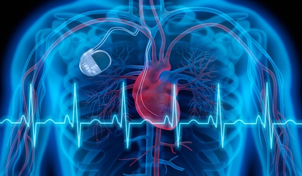 Image: Left bundle branch area pacing (LBBAP) has emerged as an effective approach for patients do not respond to standard biventricular pacing (photo credit: Adobe Stock)