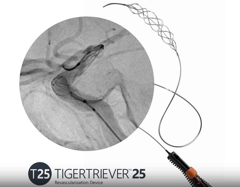Image: TIGERTRIEVER 25 is the largest thrombectomy device on the market. It combines an extended 53 mm capture length with real-time control and full visibility, enabling excellent vessel conformability as shown in the image (photo courtesy of Rapid Medical)